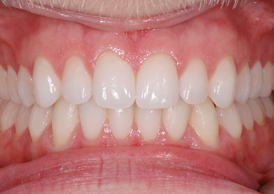 Invisalign Case 6 After